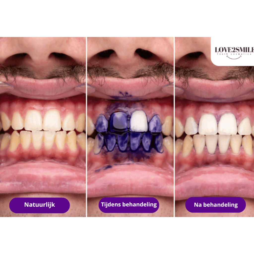 Ultimate whitening bundel